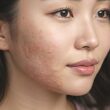 대상포진 환자의 샤워 시 주의할 점, 안내 및 샤워 방법 23