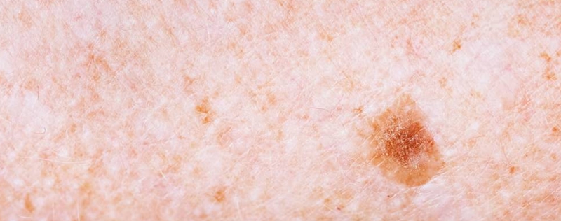 검버섯 없애는 방법과 예방법! 피부 건강을 지키는 비결 7