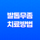발톱무좀 치료방법, 발톱에 생기는 피부사상균 침투 질환 37