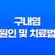 구내염의 원인 및 치료법 : 빠른 회복을 위한 전략 21
