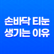 손바닥 티눈 생기는 이유와 제거하는 방법 25