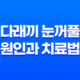 다래끼 눈꺼풀에 생기는 염증성 질환의 원인과 치료법 23