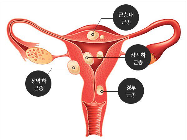 여성 자궁근종, 주요 증상 종류와 예방 방법 1