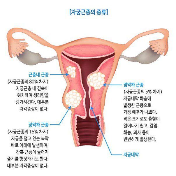 여성 자궁근종, 주요 증상 종류와 예방 방법 5