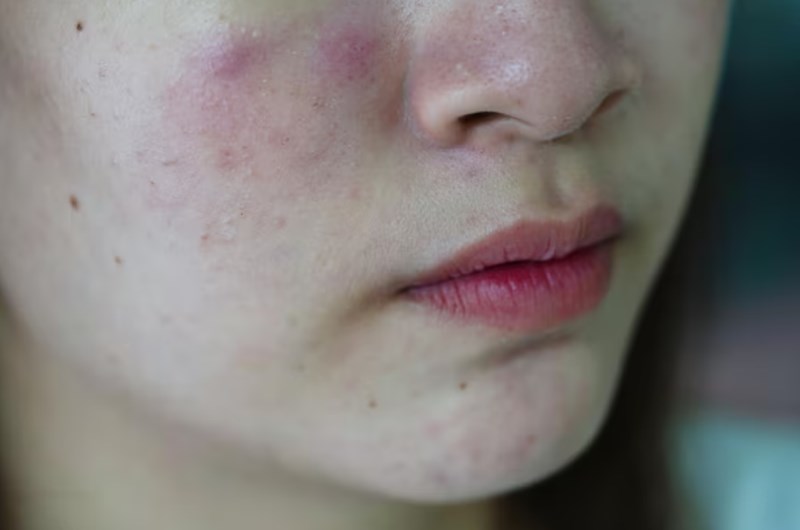 여드름 붉은 자국 없애는 방법 8 여드름 붉은 자국 없애는 방법 7