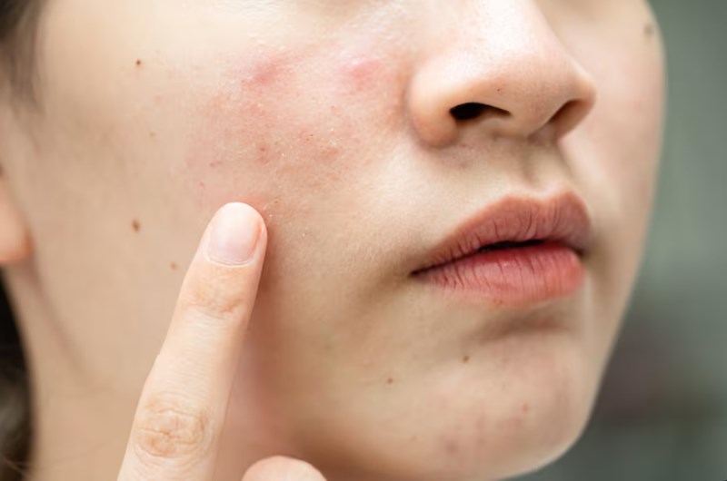 여드름 붉은 자국 없애는 방법 10 여드름 붉은 자국 없애는 방법 9