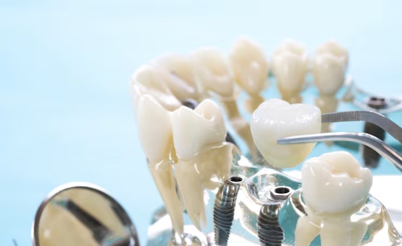임플란트의 종류