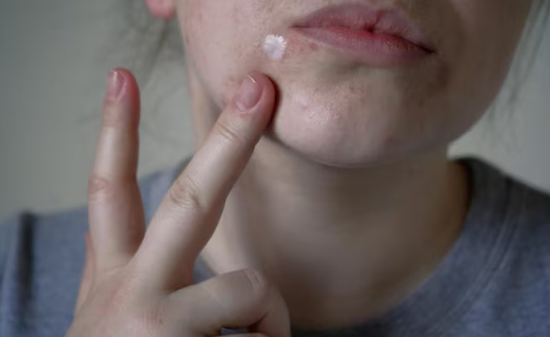 여드름 위치별 원인과 증상(+ 정확한 관리로 건강한 피부 되기) 8 효과적인 여드름 관리를 위한 조언