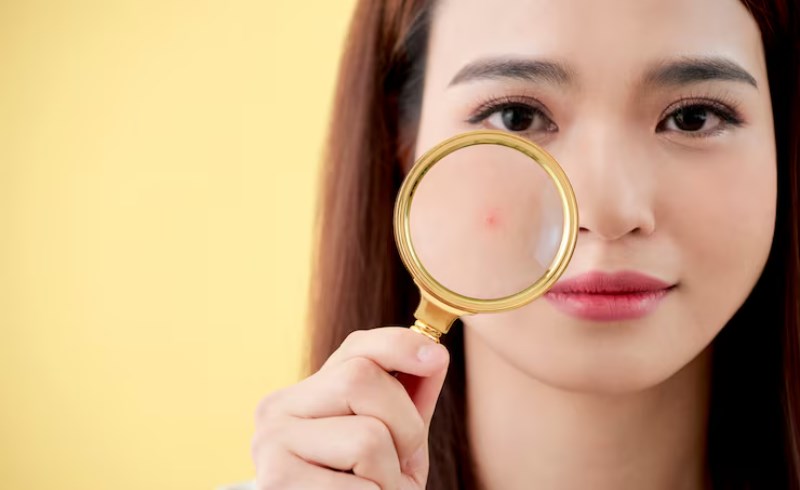 여드름 위치별 원인과 증상