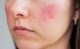 안면홍조증 원인, 증상, 치료 및 예방 방법