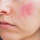 안면홍조증 원인, 증상, 치료 및 예방 방법 15