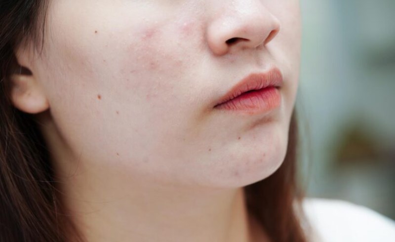 겨울철 여드름 관리(+건강한 피부를 유지하는 전략) 8 겨울철 여드름 관리 - 적절한 세안 루틴