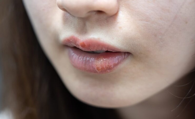입술 포진 빨리 낫는 방법