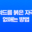 여드름 붉은 자국 없애는 방법 23