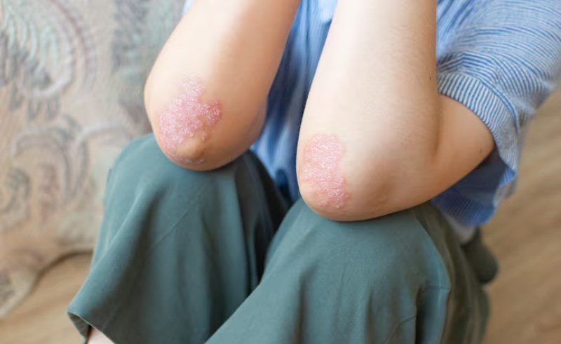 대상포진 보험 5가지 핵심 정보