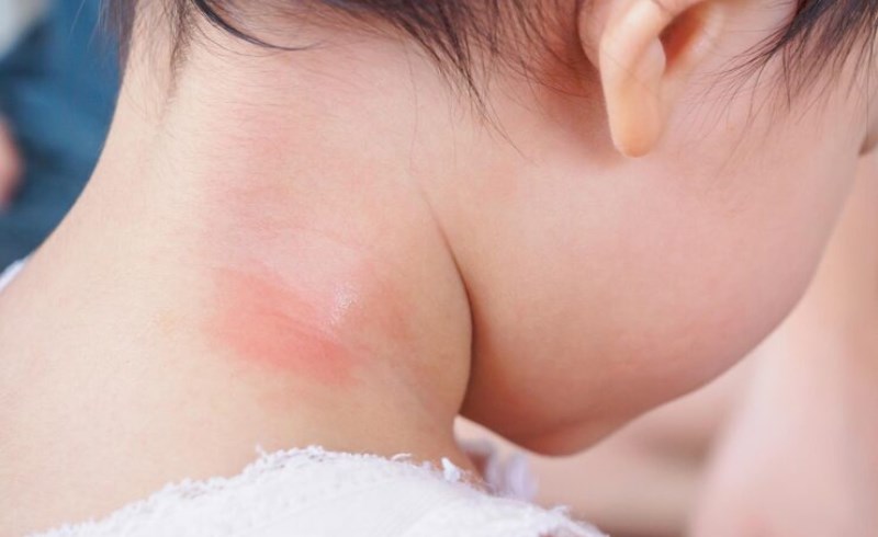 대상포진 보험 - 어떤 보장을 받을 수 있나요?