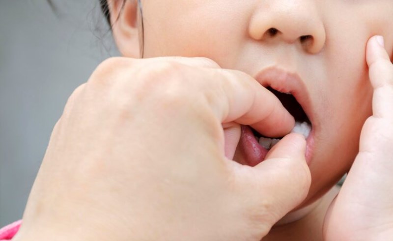 설염의 치료 방법