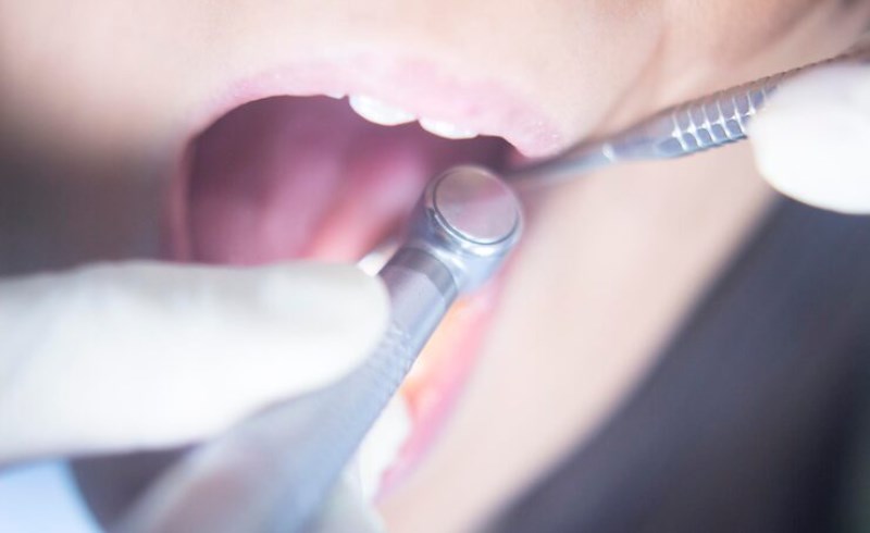 사랑니 발치 후의 식사와 일상 생활