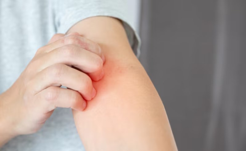 대상포진 예방하기