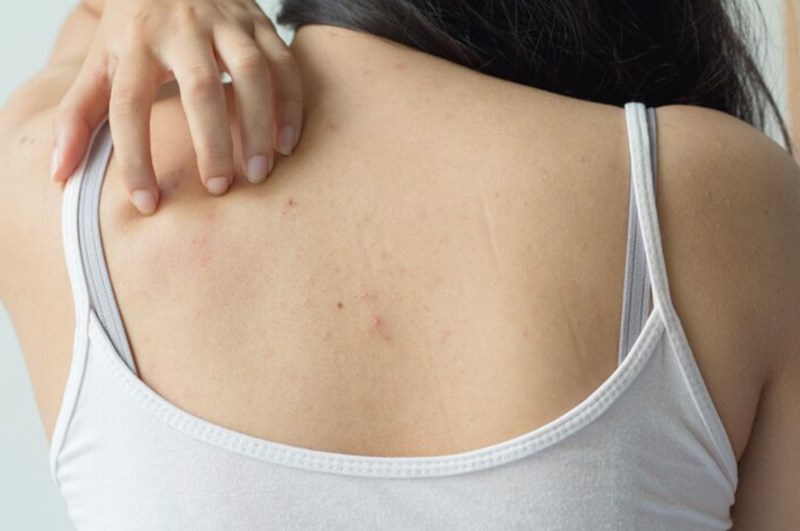 등드름 없애는 방법, 여름철 피부 고민을 해결하자! 7