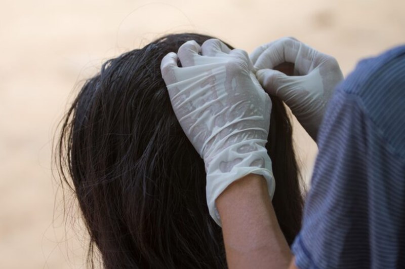 모발이식 수술 비용과 병원 고르는 방법 19