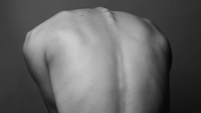 화상 치료비 심재성 2도 진단, 화상 진단비 + 실비 + 수술비 3단 콤보로 완벽하게 대비하는 법 9 화상으로 손상된 피부에 이식 수술을 하는 모습