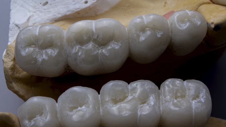 치아보험 브릿지 후기 및 지급 거절팁 7 치과 브릿지 시술 과정과 보철물 이미지