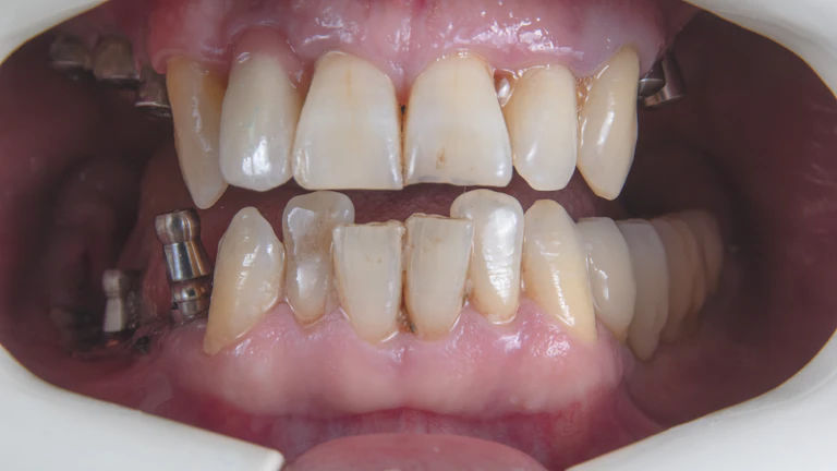 임플란트 가입조건 2026년 전액 받는 설계 꿀팁 1