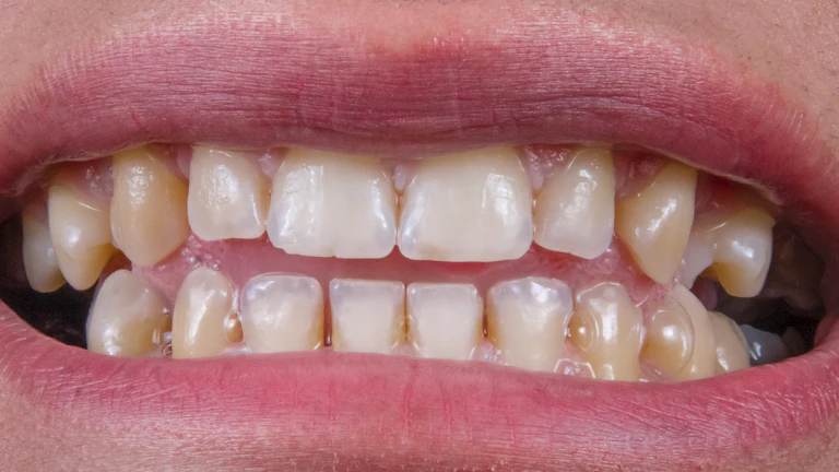 임플란트 재수술 보험금 가성비 청구 및 지급 후기 (2026년) 1