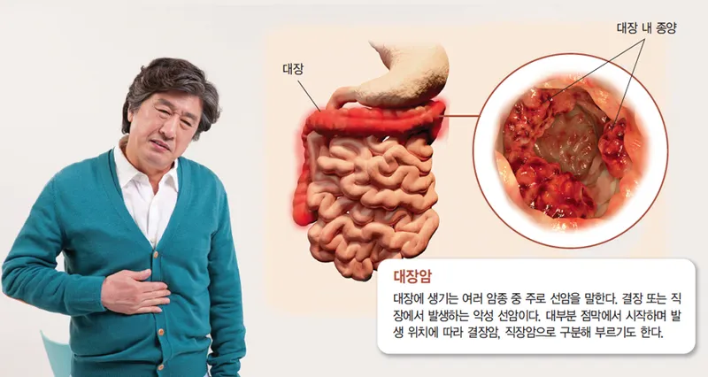 대장암 초기증상 혈변 말고 놓치기 쉬운 신호 정리 1