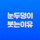 눈두덩이 붓는 이유와 눈두덩이 부기를 줄이는 방법 19